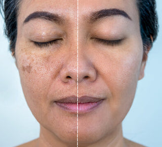 Pigmentation