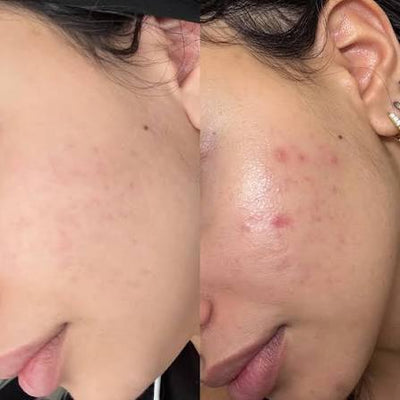 Niacinamide