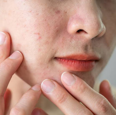 Salicylic Acid