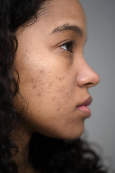 Acne/pimples