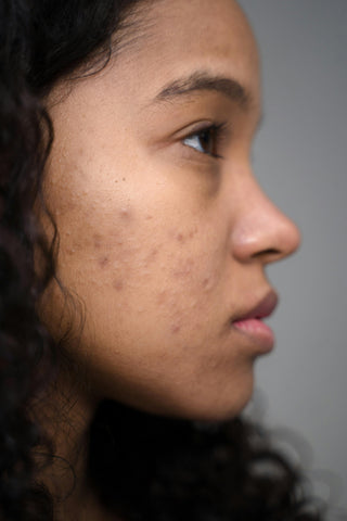 Acne & Pimples